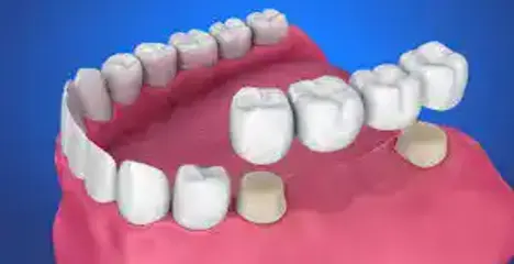 Klinik33'te zirkonyum kron ölçüsü alan protez uzmanı